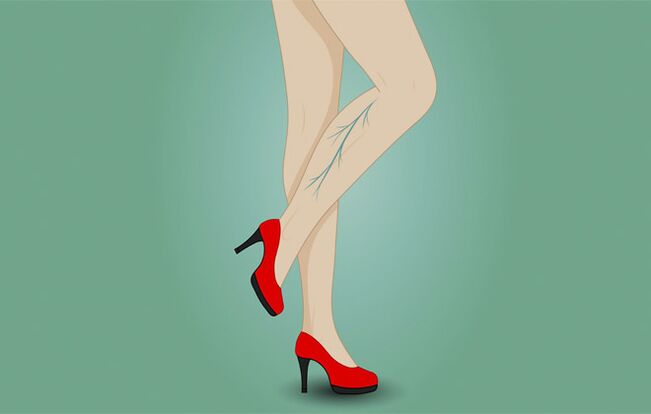 Venous veins on a woman's feet
