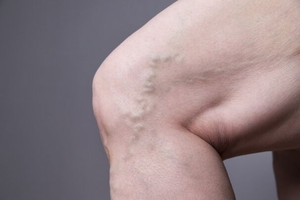 Intravenous veins in women