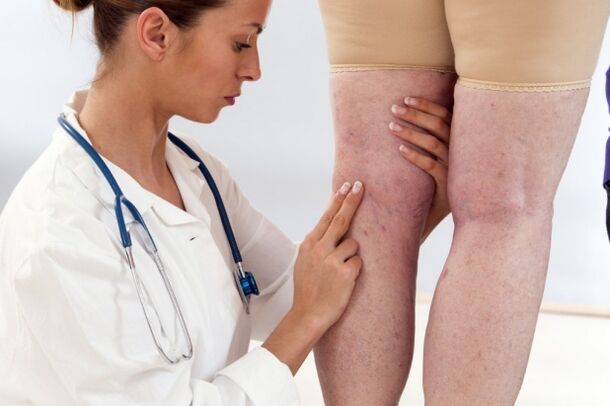 Treatment of varicose veins in women