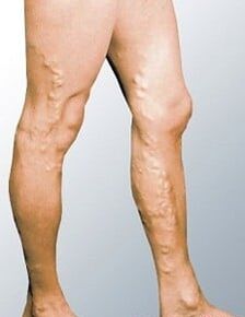 Varicose veins in men's legs