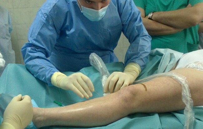 Removal of veins