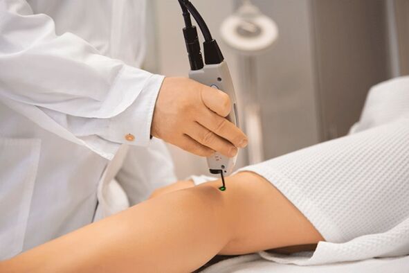 Laser coagulation of lower limb veins