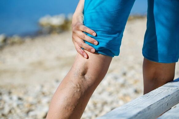 Persistent pain in the legs due to varicose veins