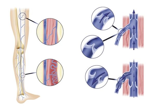 Weak venous valves lead to varicose veins