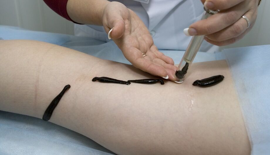 Treatment of varicose veins with leeches