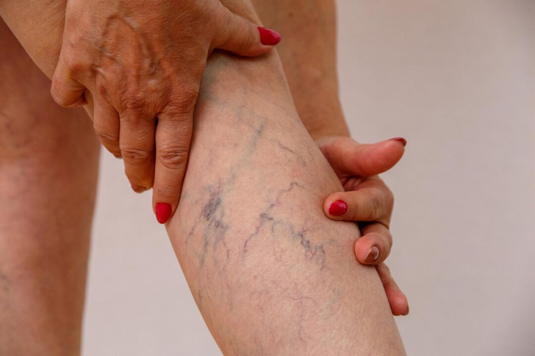 Varicose veins in legs