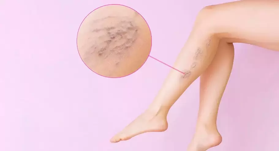 Tortuous protruding veins on legs with varicose veins