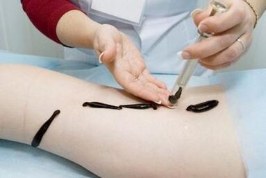 Leeches treat varicose veins - effective folk remedies