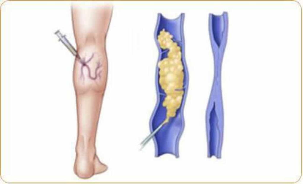 An example of a sclerotherapy procedure for varicose veins and the visible results