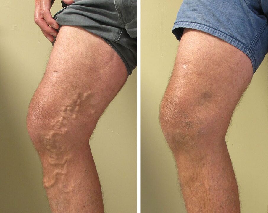 Superficial varicose veins cannot be ignored