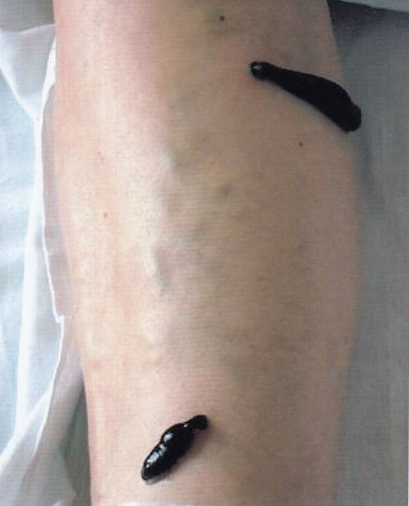 Hirudo therapy - treatment of varicose veins in the legs with leeches